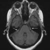 16A1 Sarcoid (Case 16) T1 without 1 copy - Copy