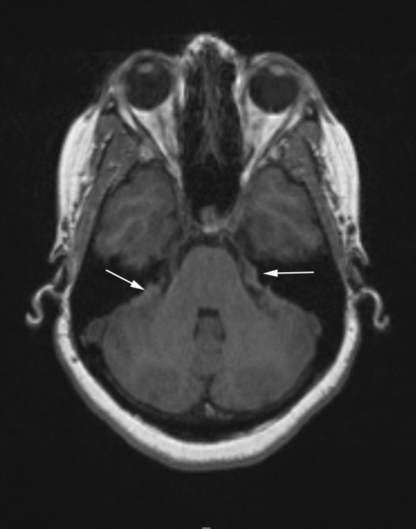 16A1 Sarcoid (Case 16) T1 without 1 copy - Copy