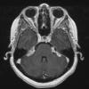 16A2 Sarcoid (Case 16) T1 with contrast 3 slice 142 of 208 - Copy (2)