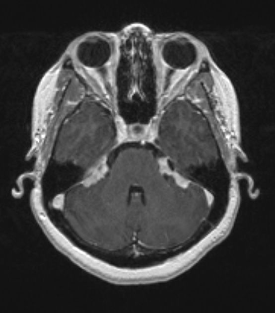 16A2 Sarcoid (Case 16) T1 with contrast 3 slice 142 of 208 - Copy (2)