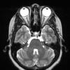 16A3 Sarcoid (Case 16) T2 with contrast 1 copy - Copy