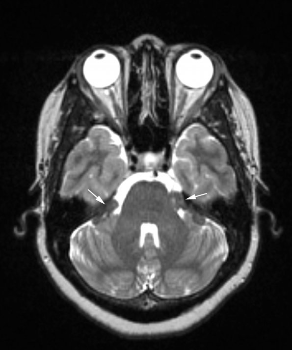 16A3 Sarcoid (Case 16) T2 with contrast 1 copy - Copy