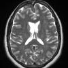 16A4 Sarcoid (Case 16) T2 with contrast 3 slice 45 of 96 copy - Copy