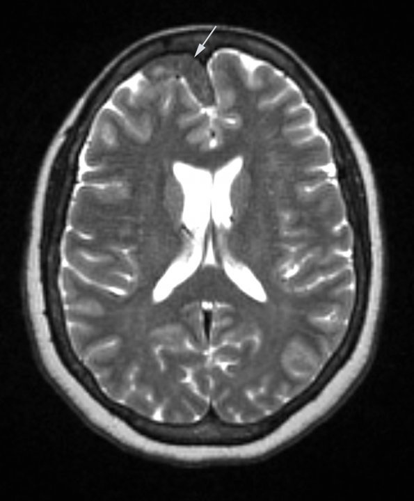 16A4 Sarcoid (Case 16) T2 with contrast 3 slice 45 of 96 copy - Copy