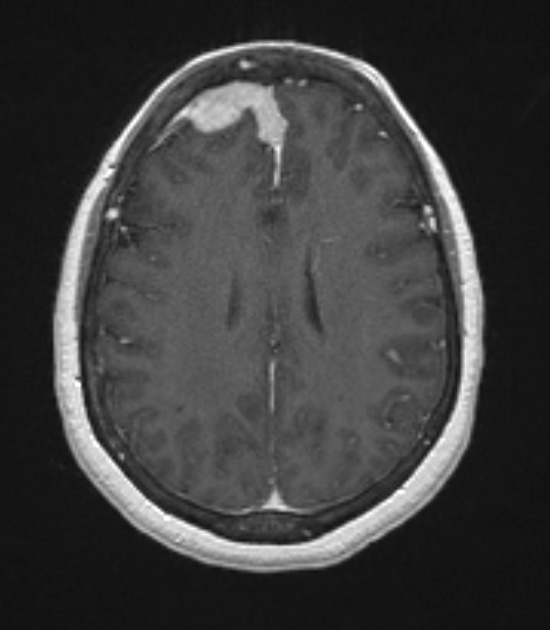 16A5 Sarcoid (Case 16) T1 with contrast 3 slice 90 of 208 - Copy