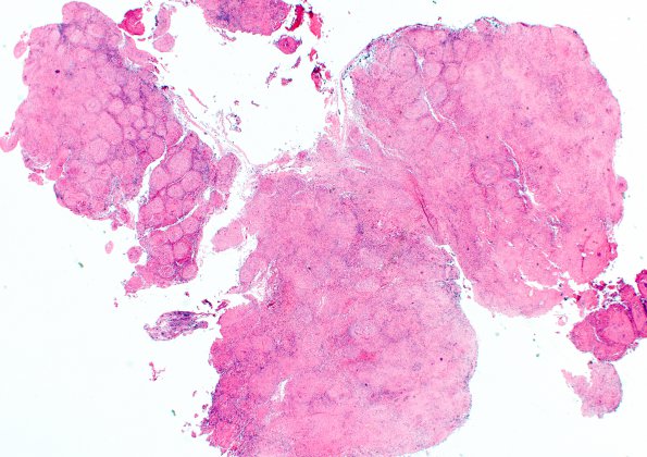 16B1 Sarcoid (Case 16) H&E 5