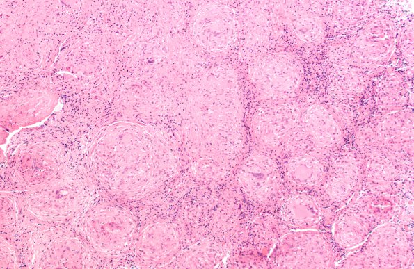 16B2 Sarcoid (Case 16) H&E 4