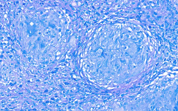 16C2 Sarcoid (Case 16) Fite 2