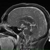 1A1 Neurosarcoid (Case 1) T1 contrast 9 - Copy