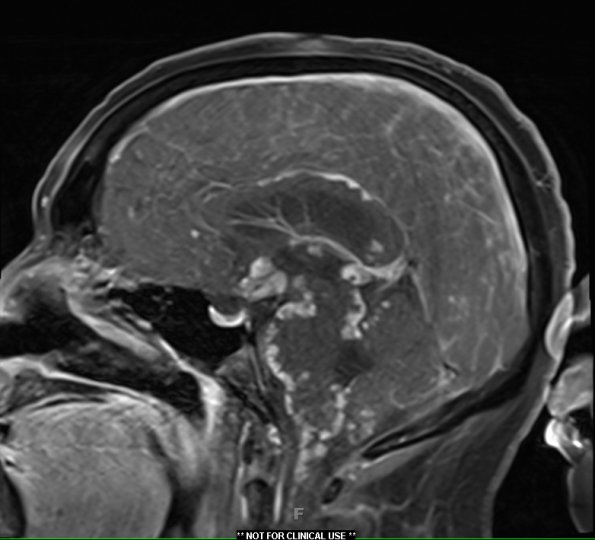 1A1 Neurosarcoid (Case 1) T1 contrast 9 - Copy