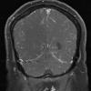 1A2 Neurosarcoid (Case 1) T1 contrast 8 - Copy