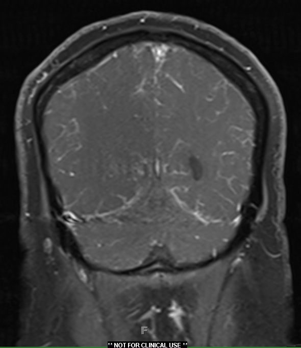 1A2 Neurosarcoid (Case 1) T1 contrast 8 - Copy