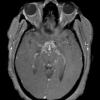 1A3 Neurosarcoid (Case 1) T1 contrast 3 - Copy