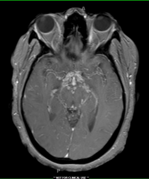 1A3 Neurosarcoid (Case 1) T1 contrast 3 - Copy