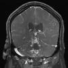 1A4 Neurosarcoid (Case 1) T1 contrast 7 - Copy