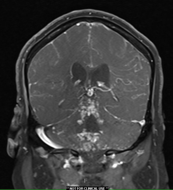 1A4 Neurosarcoid (Case 1) T1 contrast 7 - Copy