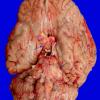 1B1 Neurosarcoid (Case 1) _3 copy