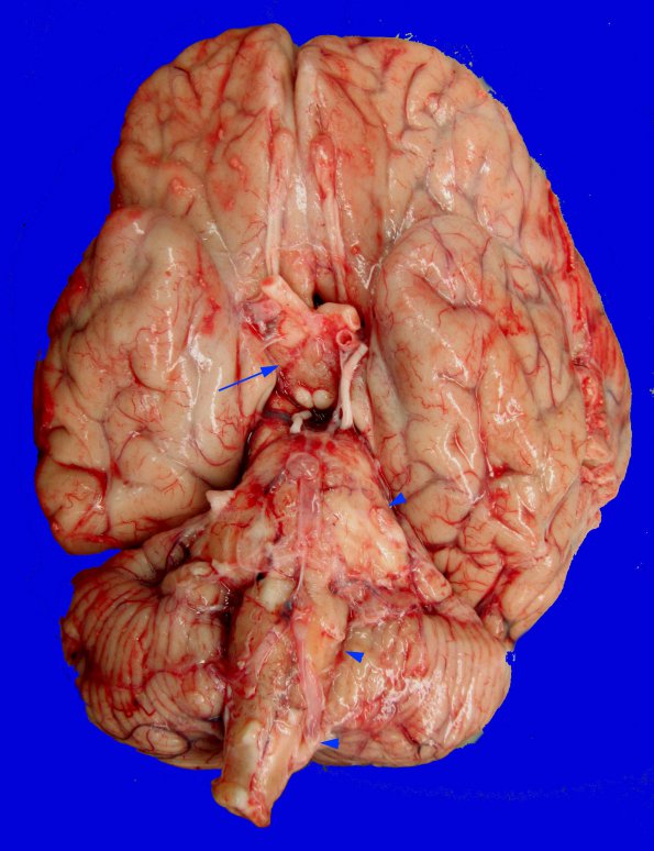 1B1 Neurosarcoid (Case 1) _3 copy