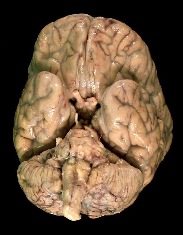 1B2 Neurosarcoid (Case 1) _5