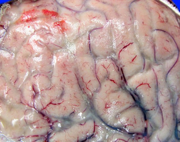 1C1 Neurosarcoid (Case 1) _1A