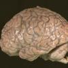 1C2 Neurosarcoid (Case 1) _6 preA