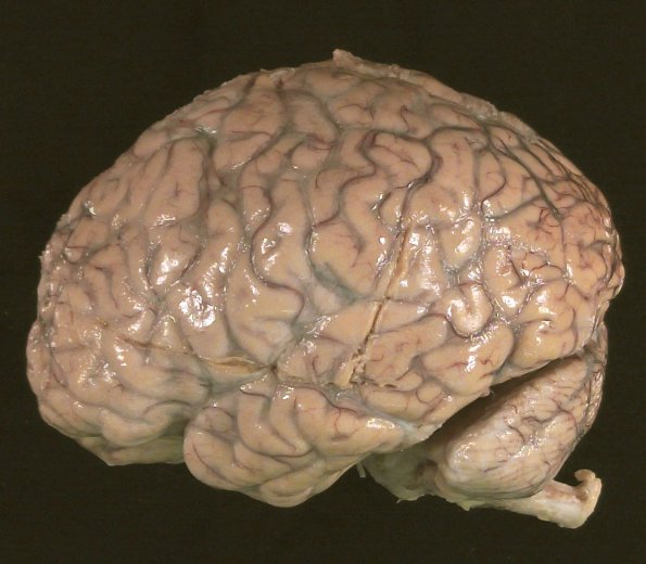 1C2 Neurosarcoid (Case 1) _6 preA