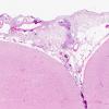 1C3 Neurosarcoidosis (Case 1) N1 H&E 2