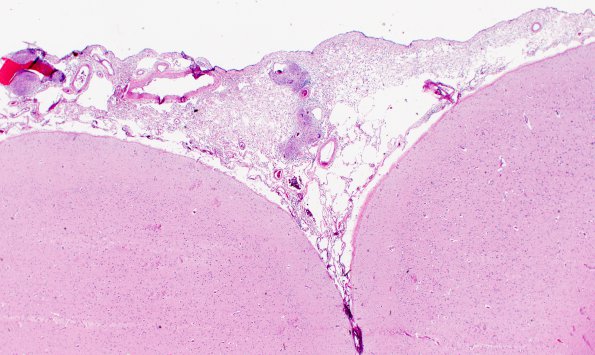 1C3 Neurosarcoidosis (Case 1) N1 H&E 2