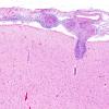 1C4 Neurosarcoidosis (Case 1) N1 H&E