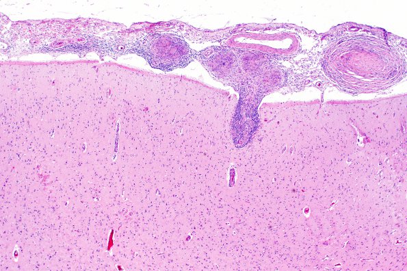 1C4 Neurosarcoidosis (Case 1) N1 H&E