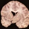 1D1 Neurosarcoid (Case 1) _32