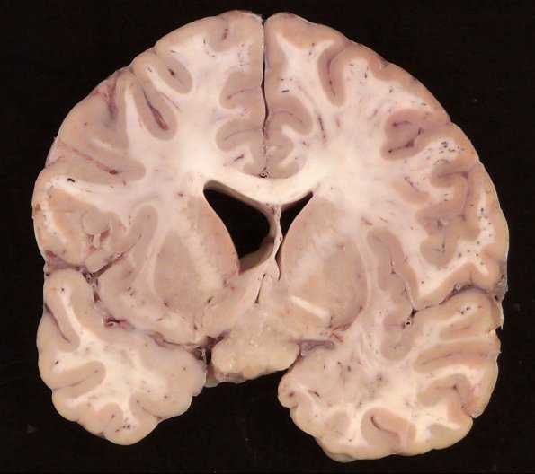 1D1 Neurosarcoid (Case 1) _32