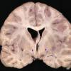 1D3 Neurosarcoid (Case 1) _40 copy