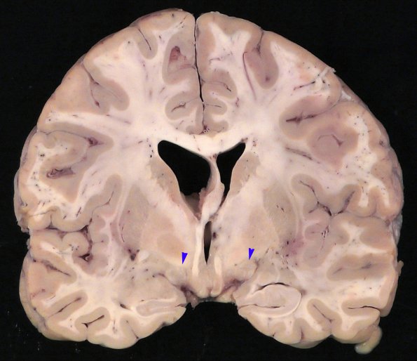 1D3 Neurosarcoid (Case 1) _40 copy