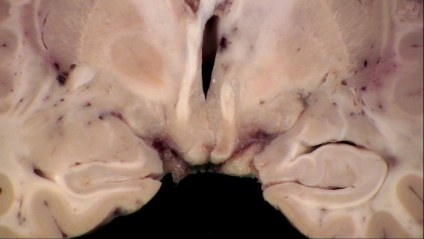 1D4 Neurosarcoid (Case 1) _42