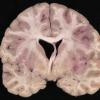 1D5 Neurosarcoid (Case 1) _16