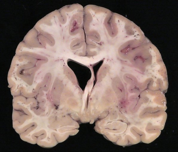 1D5 Neurosarcoid (Case 1) _16