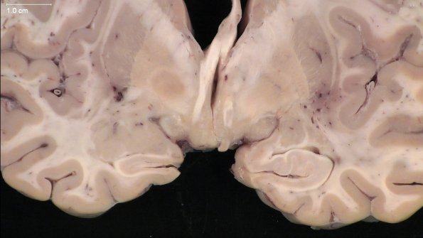 1D6 Neurosarcoid (Case 1) _37