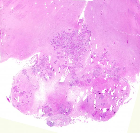 1E1 Neurosarcoidosis (Case 1) N14 H&E whole mount