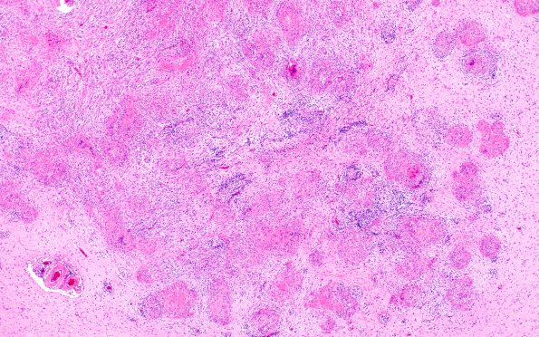 1E2 Neurosarcoidosis (Case 1) N14 H&E 5