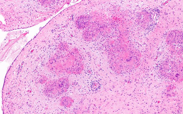 1E3 Neurosarcoidosis (Case 1) N14 H&E 2