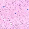 1E5 Neurosarcoid (Case 1) N3 H&E 1 copy