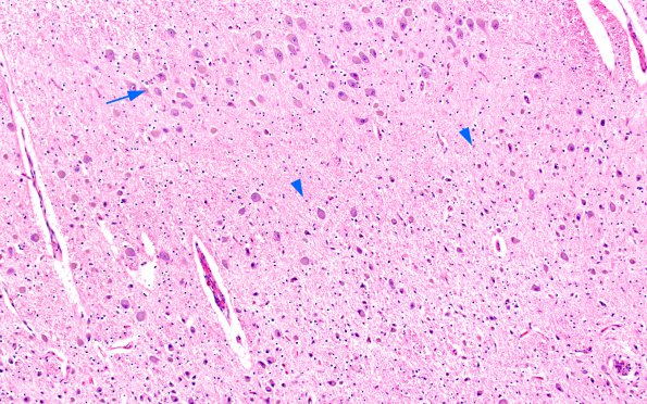 1E5 Neurosarcoid (Case 1) N3 H&E 1 copy