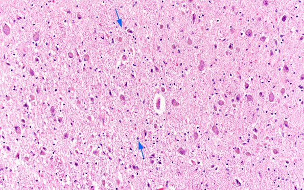 1E6 Neurosarcoid (Case 1) N3 H&E 3 copy