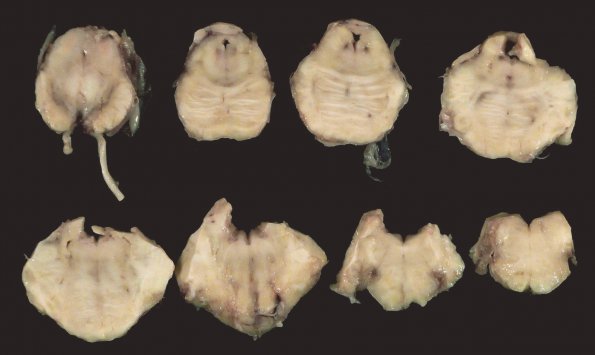 1F1 Neurosarcoid (Case 1) _25