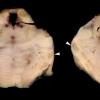 1F2 Neurosarcoid (Case 1) _44 copy