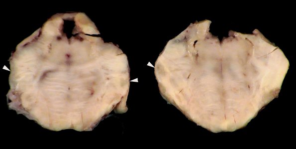 1F2 Neurosarcoid (Case 1) _44 copy