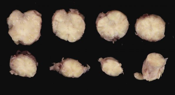 1F3 Neurosarcoid (Case 1) _26