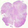 1G1 Neurosarcoidosis (Case 1) N8 H&E 5