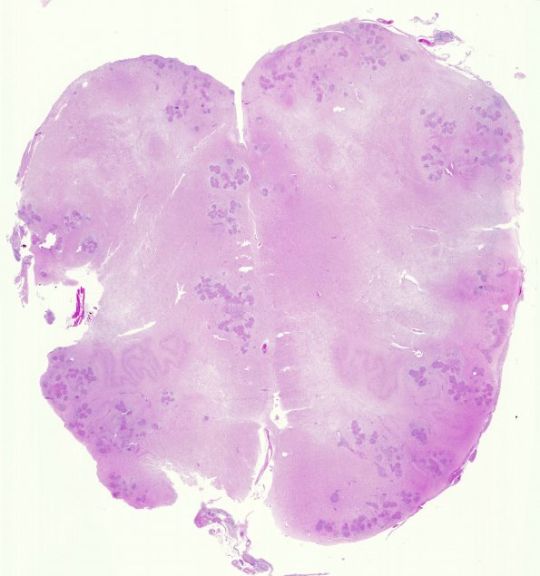 1G1 Neurosarcoidosis (Case 1) N8 H&E 5